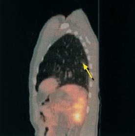 Soliter Pulmoner