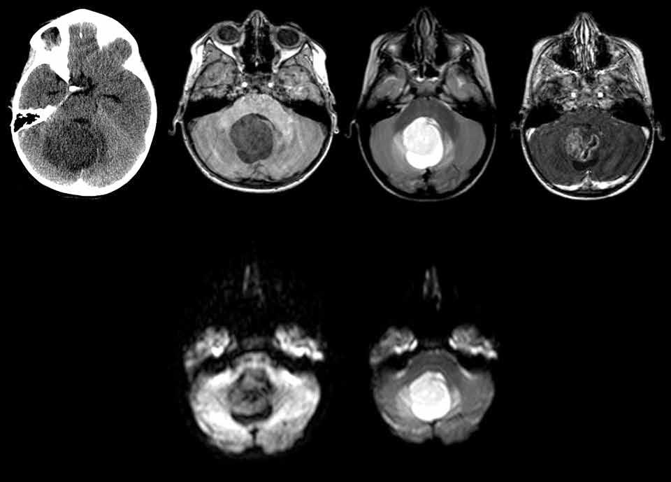 A b c d e f Şekil 1: Kontrastsız beyin BT tetkikinde vermis kaynaklı her iki serebellar hemisferi invaze eden hipodens kitle lezyonu izleniyor (a).