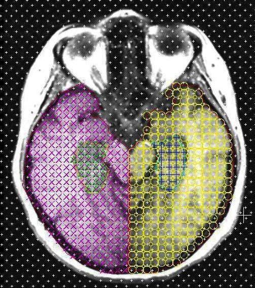 51 Şekil 30. Bir olguya ait kesitte sınırları farklı renklerle çizilmiş sol ve sağ hippocampus ile beyin yarım küreleri gösterilmektedir. Daha sonra 0.5 cm.