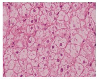 Glikojen Depo Hastalıklarında Sık Görülen Bulgular Hepatomegali Hipoglisemi Karaciğer fonksiyon bozukluğu Kas güçsüzlüğü Miyopati,