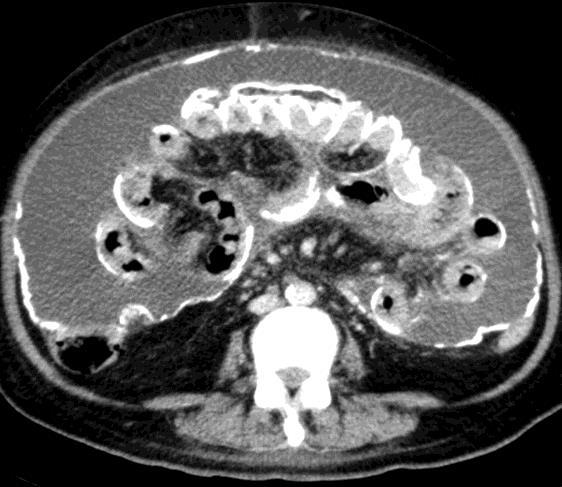 Kidney Int 2010; 77: 904 İngiltere; 5 yılda % 8.1 Brown MC et al.