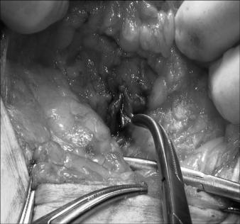 meliyat sonrası 2-3 cm lik periareolar insizyonun görünümü, cerrahi alanda minimal deformite Duktoskopide epitel yüzey düzensizliği ve hiperemi tespit edilen bir hastada Duktoskopi Eşliğinde Duktal