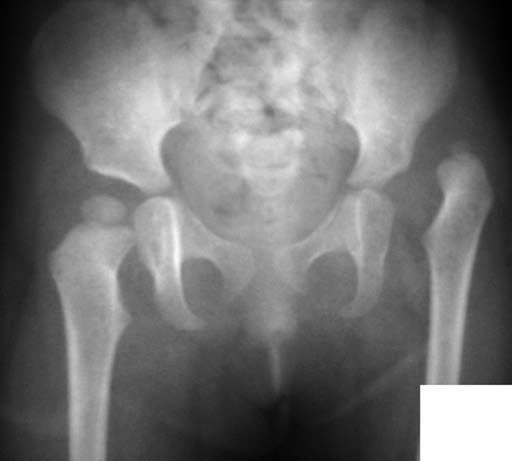14 Eklem Hastalıkları ve Cerrahisi - Joint Dis Rel Surg Gelişimsel kalça displazisi (GKD), çocukluk çağı ortopedik patolojilerin en önemli ve tedavisi en tartışmalı hastalıklarından biridir.