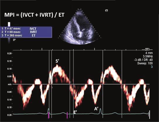 ile elde edilir (Şekil 7). PH li hastalarda sağ ventrikül MPI da artış izlenir (Tablo 2).