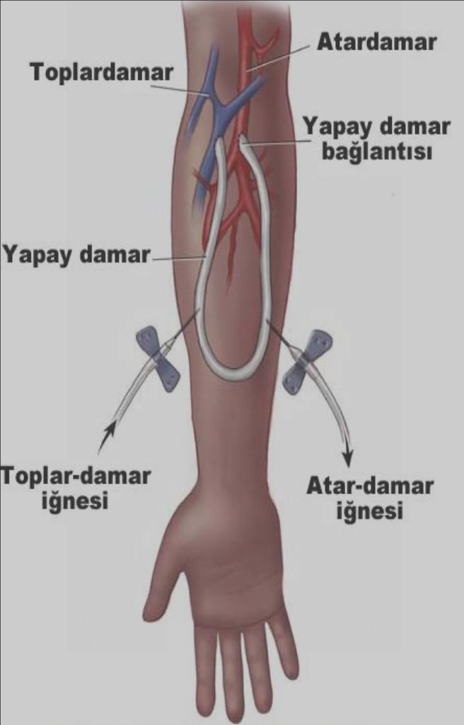Arter ve ven arasına PTFE sentetik bir damarın yerleştirilmesidir AVF de damar iyi gelişmemişse Damar yapısı bozulmuşsa