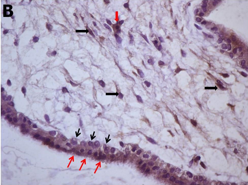 sitotrofoblastlara (siyah ince oklar) göre daha güçlü immünoreaktif sinsityotrofoblastlar