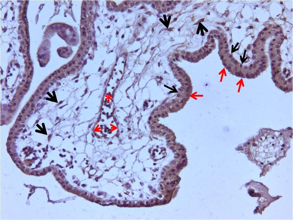 88 Otoimmün hastalık grubuna ait örneklerdeki tersiyer koryon villuslarında da kontrol grubunda olduğu gibi sitotrofoblastların, sinsityotrofoblastların, mezenkimal bağ dokusu hücrelerinin ve