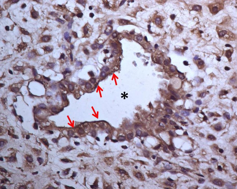 103 Şekil 4.2.4.b.2: Beclin-1 DM grubu; endometriyumdaki bezleri (yıldız) döşeyen epitel hücrelerinde hücrelerinde (kırmızı oklar) belirgin immunoreaktivite, (ABC Yöntemi-Hematoksilen X400).