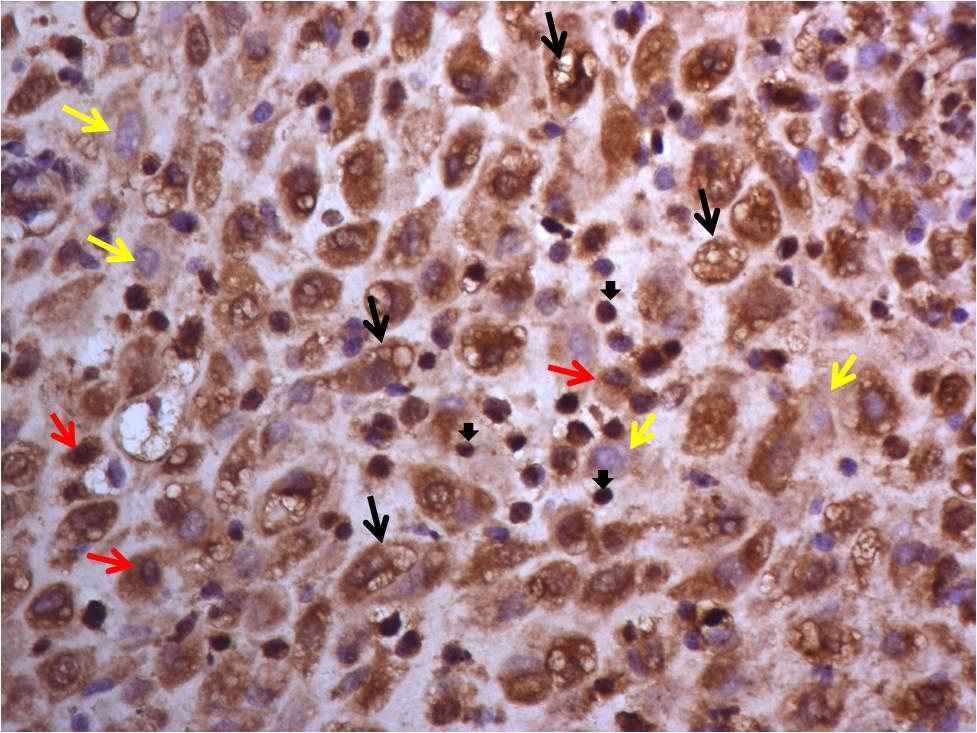 107 MTHFR grubu endometriyumunda stromal hücreler, ekstravillöz trofoblastlar ve lenfositlerde kontrol grubuna benzer sitoplazmik immünoreaktivite izlendi.