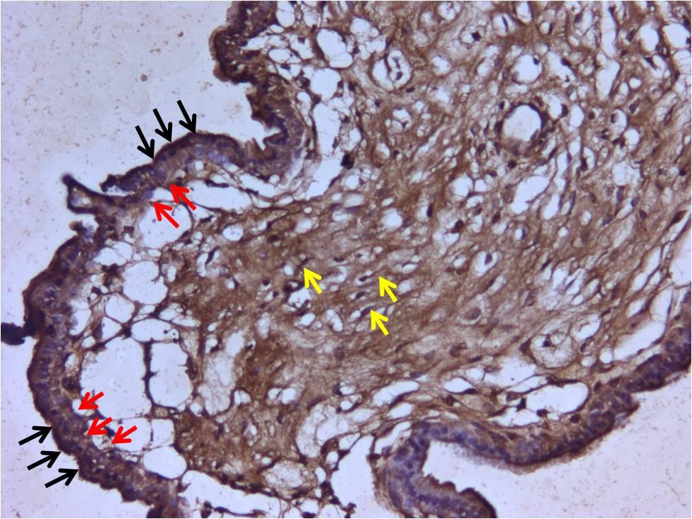 108 MTHFR grubuna ait villusların sitotrofoblastlarında ve sinsityotrofoblastlarında otoimmün grubuna benzer şekilde kontrol grubuna göre daha güçlü sitoplazmik immünoreaktivite izlendi.