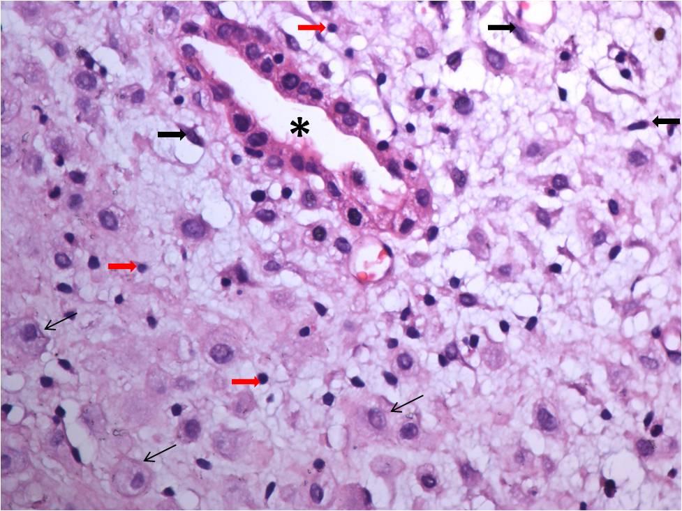 51 görünüm sergileyen bez epitel hücreleri (oklar), (Hematoksilen-Eozin AX100, BX400). İncelenen örneklerin tümünde endometriyumda desidualizasyona özgü değişikler görüldü.