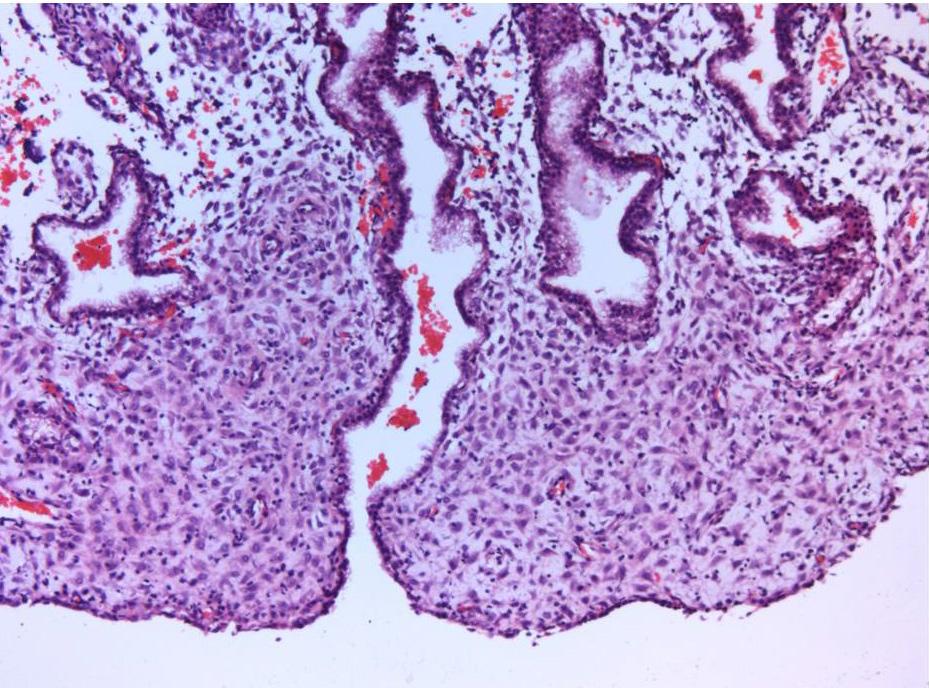 58 4.2.1.c. MTHFR Grubu MTHFR grubuna ait 8 adet örnek incelendi. Örneklerinin hepsinde endometriyum dokusu, 2 tanesinde ise endometriyum dokusunun yanında koryon villusları izlendi.