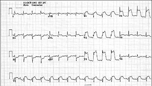 Tanım MI a ait tipik klinik bulgular Anamnez Retrosternal EKG de devam basınç, eden ağırlık, ST elevasyonu yanma hissi Omuz, kollar, boyun, çene,