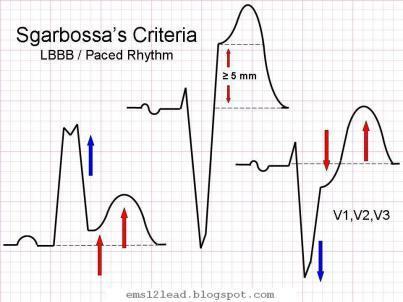Sol dal bloğu Sgarbossa kriterleri QRS ile konkordant 1mm ST elevasyonu olması (5) V1,V2 veya V3 de 1mm