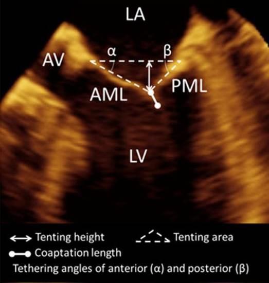 Cerrahi tamir sonrası mitral yetersizliği nüks riskini arttıran ekokardiyografi parametreleri Kordal gerilme göstergeleri: Anterior yaprakçık açısı >25 Koaptasyon derinliği >10 mm Posterior yaprakçık