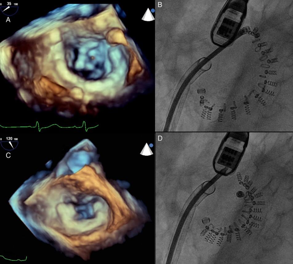 Cardioband