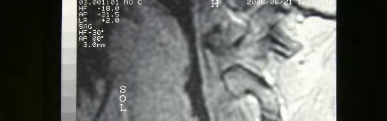 thyrohyoidea laterale sinistra nın