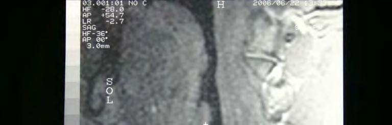 A Şekil 11. A. Grup II e ait erkekten alınan MR görüntüsü. ı: lig. thyrohyoidea laterale dextra nın ölçümü.