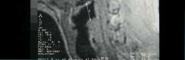 Şekil 15. A. Grup II e ait kadından alınan MR görüntüsü. ı: lig. thyrohyoidea laterale dextra nın ölçümü.