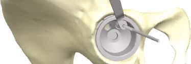 Screw Fixation Vidanýn Fiksasyonu Press Fit Cup Should additional screw fixation be necessary, holes are drilled (Ref:10809071040-50) in the direction of the sacro-iliac joint using the drill guide