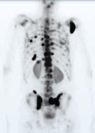 pelvistedir 3 a. Otopside saptanan kemik metastaz insidansı 1. Coleman R, et al. Cancer Treat Rev.