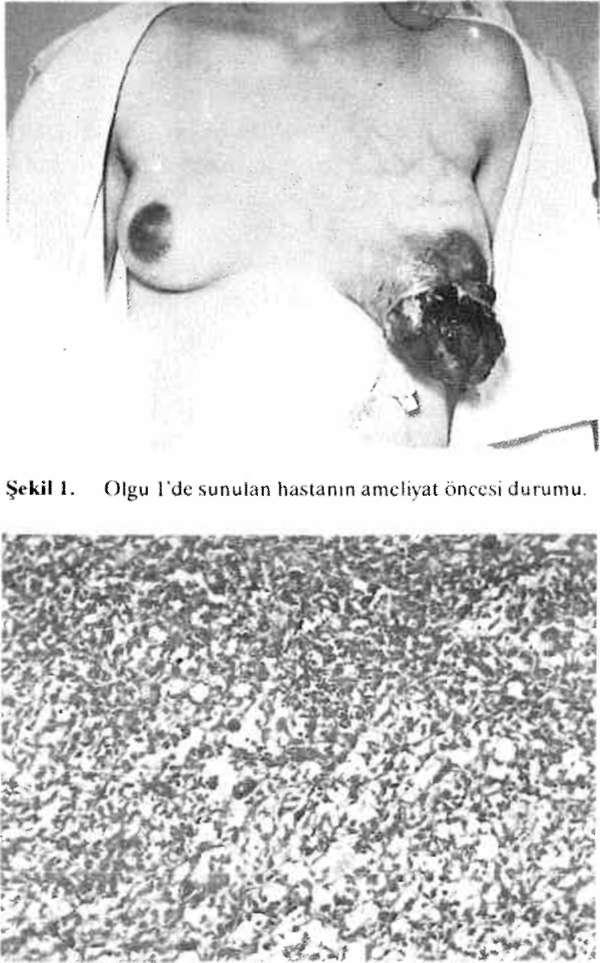Olgu l'de sunulan hastanın meme tümörünün hıstopatolajik kesiti (115x, ILI:.). Olgu 1 (S.