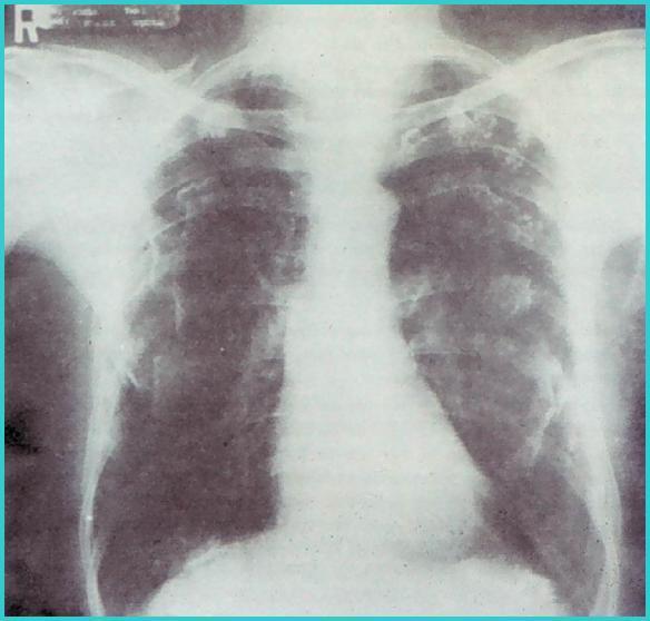 Asbest Bağlı Akciğer ve Plevra Hastalıkları Plevral Hastalıklar -Diffüz