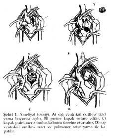B. Akpınar ve ark. Pulmoner Kapak Replazmanı Sonuç Olgular ameliyat sonrası 12.3 ay takip edildi.