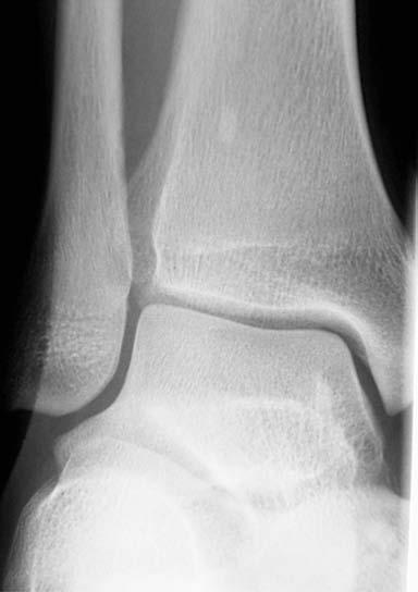 B: Hastanın sağlam sağ ayak bileği Mortise grafisinde normal eklem aralıkları görülmektedir.