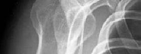 kırığı (lateral plato) * Patellar kırıklar (vertikal veya oblik) Osteokondral kırıklar ve ligament veya menisküs yaralanmaları * Ayak bileği malleol kırığı Ligament yırtığı veya instabilitesi Beşinci