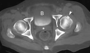 Olgu 5: Y şeklinde asetabulum kırığı Asetabulumun posterior Asetabulum kırığı / Olgu 5 sütunu (ilioiskiyal hat) mediale doğru yer