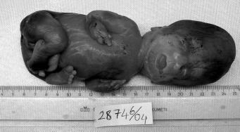 oldu u izlendi (Resim 3). Otopsi incelemesinde 320 gr erkek fetusun baflmakat uzunlu u 16.5 cm, bafl-topuk uzunlu u 20 cm idi (Resim 4).