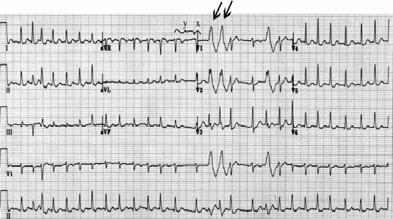 kullanılabilir (B-bloker, Ca kanal blokerleri) Hız kısıtlandıktan sonra medikal kardiyoversiyon için prokainamid verilebilir Digoksin bir diğer alternatif olabilir Atrial Fibrilasyon EKG özellikleri;