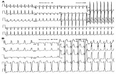 AVRT (ortodromik reciprocating tachycardia) Paroksismal Supraventriküler Taşikardi (PSVT) Unstabil hastalara senkronize kardiyoversiyon uygulanır 50-100 J ile başlanır Stabil hastalara vagal