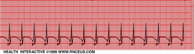 Taşikardi Junctional Taşikardi EKG özellikleri; Hız : >100/dakika Ritim : Düzenli P dalgası : Atriuma retrograd gönderilir ve pozitif derivasyonlarda negatif, negatif derivasyonlarda pozitiftir P-R