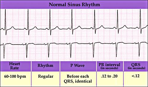 Normal EKG nin Özellikleri Normal bir EKG nin (Sinüs Ritm) sahip olması gereken özellikler: Öncelikle kalp hızını değerlendirin. Erişkin bireylerde kalp hızı 60 ile 100 aralığında olmalıdır.