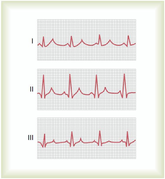 Şekil 2. 7 : Standart bipolar ektremite derivasyonları ile kaydedilen elektrokardiyogram [18] 2.4.