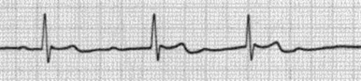 Şekil 2. 25 : Mobitz tip I (Wenkebach) blok http://lokman.cu.edu.tr/anestezi/tayfunguler/files/aritmiler.htm 2. İkinci derece kalp bloğunun diğer tipi Mobitz tip 2 AV kalp bloğudur.