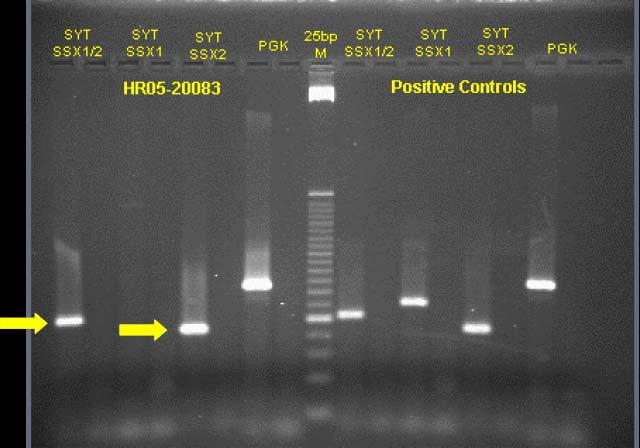 21;q11) t(x;20) - nadir SSA: AGACCAACACAGCCTGGACCAC SSX1-REV2: ACACTCCCTTCGAATCATTTTCG 109 SYT-SSX2 SYT: CAACAGCAAGATGCATACCA SSX2: GGGCACAGCTCTTTCCCATCA 331 SS18L1-SSX1 SS18L1-SSX2 SYT/SS18L1: GG