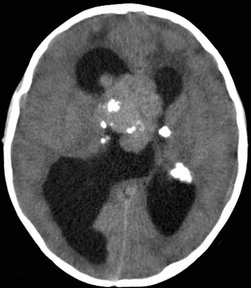 Tablo I: Pediatrik Gliomlar Solid Gliomlar Difüz Gliomlar 1. Pilositik Astrositom (WHO I) 1. Difüz Astrositom (WHO II) 2. Pleomorfik Ksantoastrositom (WHO II) 2. Anaplastik Astrositom (WHO III) 3.