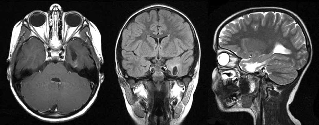 PI3K bu tümörün oluşum mekanizmasında kilit rol oynamaktadır. PI3K, AKT ve mtor inhibitörleri DIPGlerde ilaç hedefi olarak kullanılabilirler.