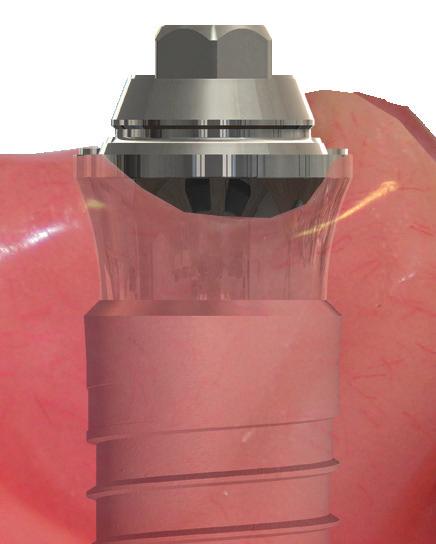 17 ve 30 açılı Dyna Multi-Unit abutment; laboratuarın, oturmuş olan implantların farklılık durumlarını telafi etmesini ve nihai protez için bir giriş yolu oluşturmasını sağlar.