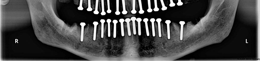 2.10-13). Şekil 2.10. 0,5 cm lik yer değişikliğini gösteren düzenek fotoğrafı.