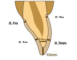 3 Full contour: Kole sırtının iç kenarı kaygan olmalı veya yivli olmalıdır. Kesici kenarın, labiyal tarafın ve damak kenarının minimum genişliği en az 0,7 mm'dir.