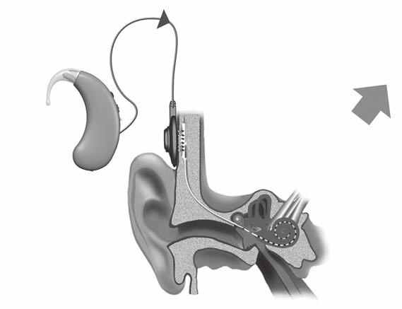 Neuro One Nasıl Çalışır? Koklear implant sistemi bir dış parça ve bir iç parçadan oluşur. Dış parça Kulak arkasında bulunan, iki mikrofonlu bir Neuro One işitme cihazı (1).