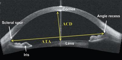 v ARA500 (Angle Recess Area 500 (mm2)): Skleral mahmuzdan 500 mikron öne doğru uzaklıktaki iris yüzeyinden, korneo-skleral iç duvardan ve açıdan geçen noktaların birleştirilmesinden oluşan üçgen