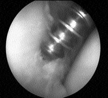 Labrumun anterior bölümü Bankart lezyonu, humerus bafl posterolaterali Hill-Sachs lezyonu aç s ndan de erlendirildi. Rotator manflet ve biseps tendonunda ek patoloji varl araflt r ld.