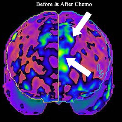 tedavisine bağlı olarak görülebilmektedir. Kemoterapi almış olan meme kanseri sağ kalanlarında %83 oranına kadar çeşitli kognitif fonksiyonlar görülebilmektedir.