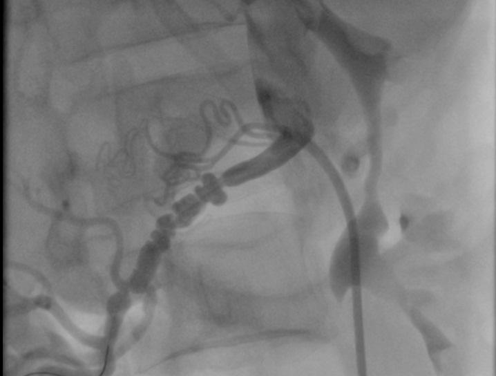 Şekil Açıklamaları Resim 1: Sağ renal anjiyografide, fibromusküler displazi için tipik