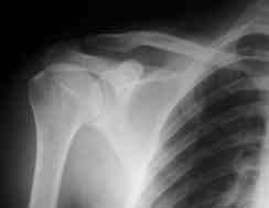 74 Acta Orthop Traumatol Turc Sa lam tarafla karfl laflt r ld nda aktif omuz d fl rotasyonunda hafif güç kayb gözlendi.